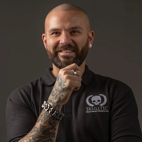 Scalp Micropigmentation in Glasgow, Scotland and UK