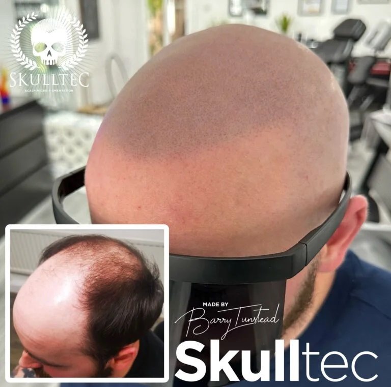 Best Scalp Micropigmentation Cost in Kent