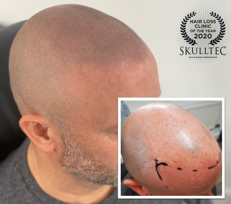 Scalp Micropigmentation in Glasgow | SMP Glasgow - Skulltec