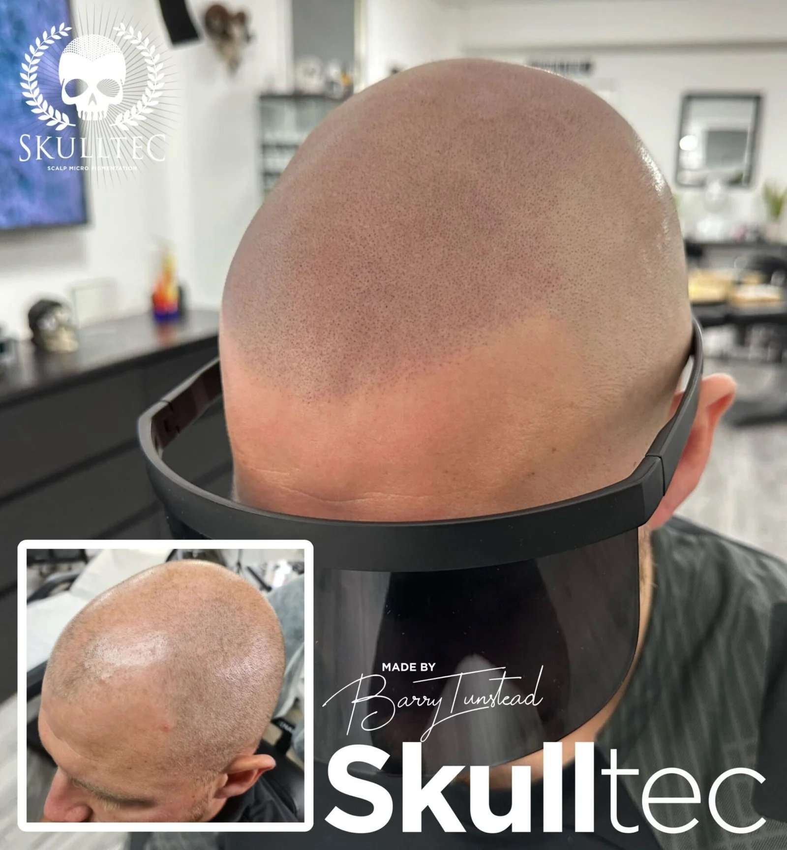 Best Scalp Micropigmentation Price in London